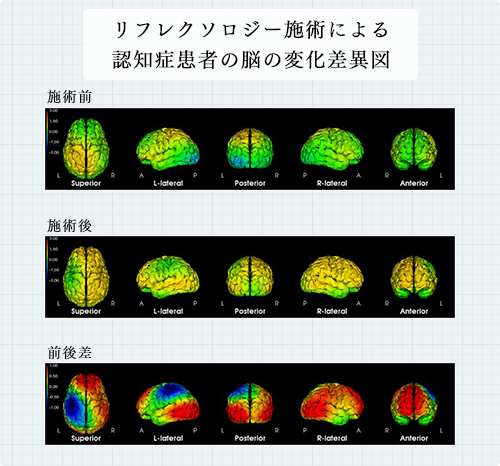 リフレクソロジー施術による 認知症患者の脳の変化差異図｜リフレクソロジーを学ぶなら日本リフレクソロジスト養成学院REFLE（リフレ）