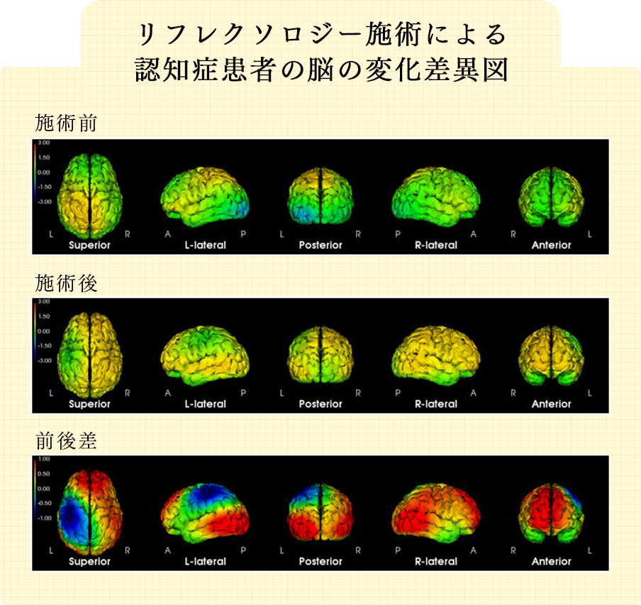 リフレクソロジー施術による認知症患者の脳の変化差異図｜リフレクソロジーを学ぶなら日本リフレクソロジスト養成学院REFLE（リフレ）